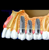 treatment-implants.jpg